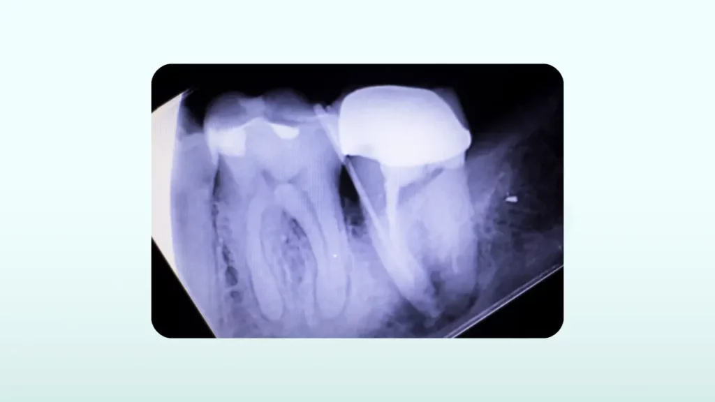 کوتاه بلند بودن روکش دندان