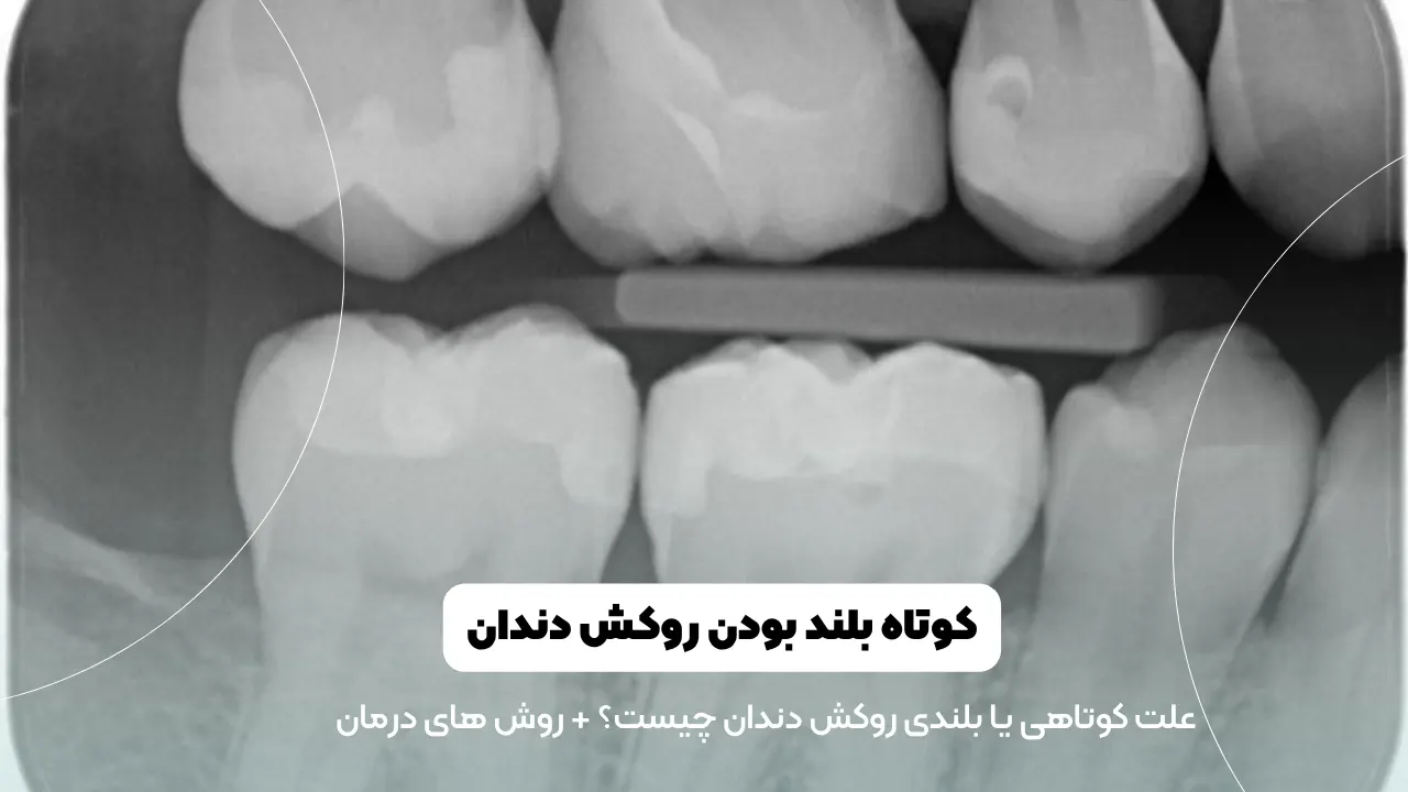 کوتاهی و بلندی روکش دندان