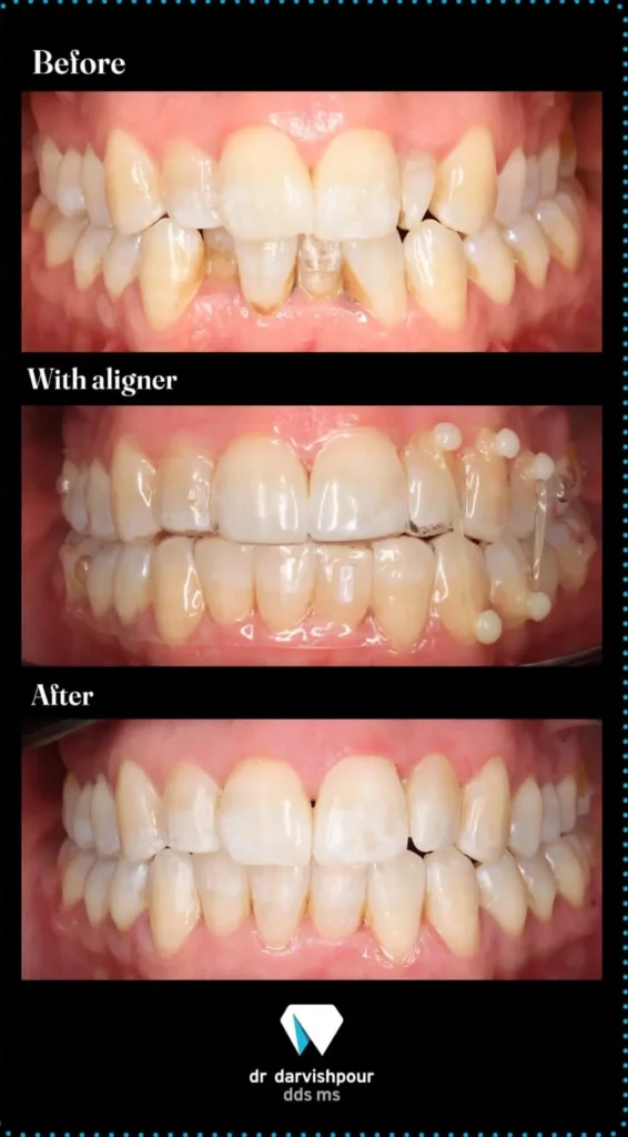 نمونه درمان ارتودنسی دکتر هادی درویش پور