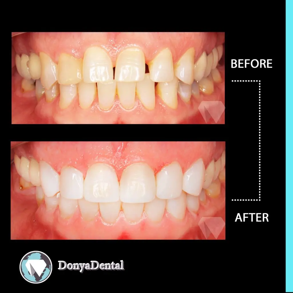 نمونه کار ترمیمی و زیبایی کلینیک دنیال دنتال